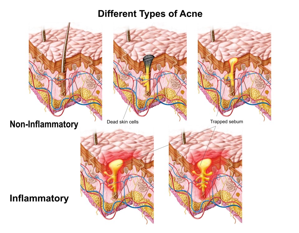 Acne occurs when bacteria, dead skin cells and natural oils become clogged in our pores