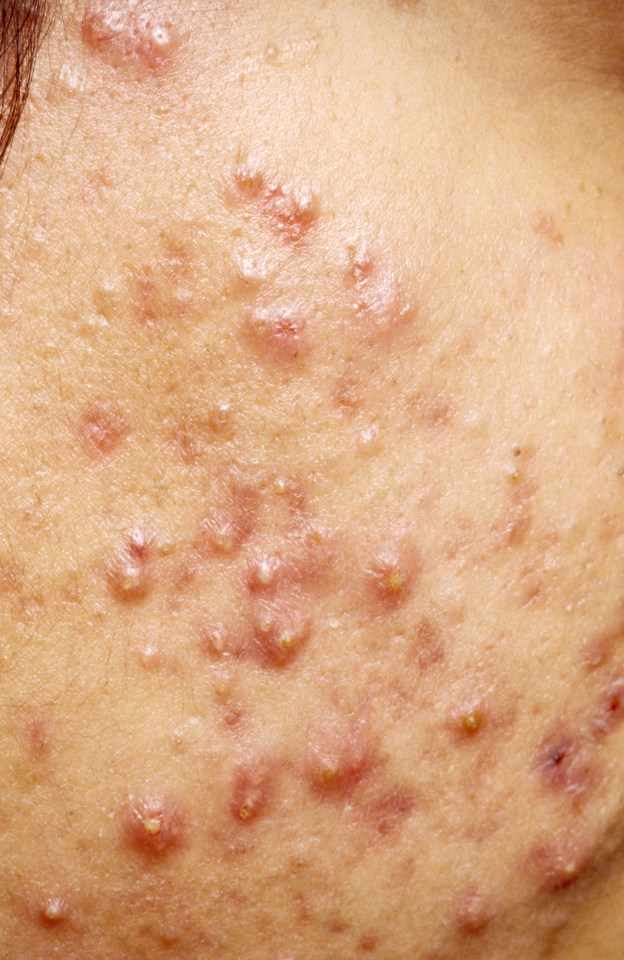 If you have cystic acne you shouldn't pop it - speak to a dermatologist about specialised treatment instead