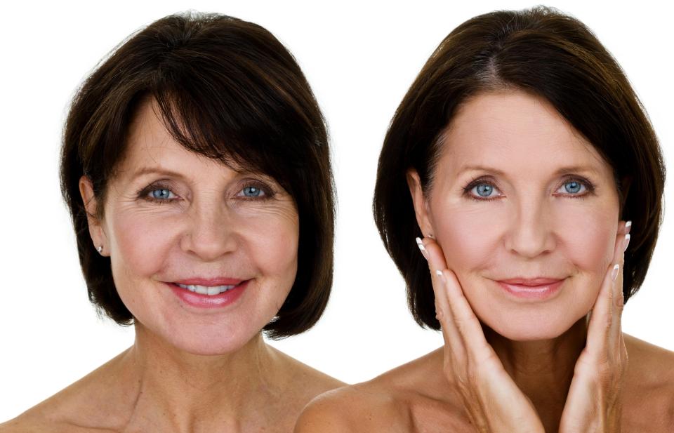  Customers might choose a mini facelift over a full procedure, which uses Botox and bio-compatible wires