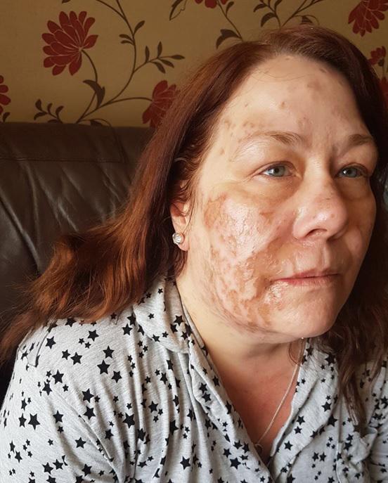  Joanne Rand died 11 days after having acid thrown over her