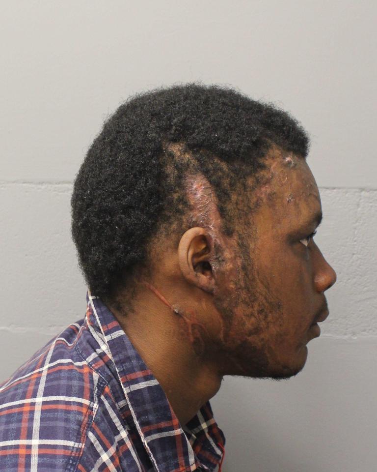  Webster suffered facial injuries in a separate acid attack