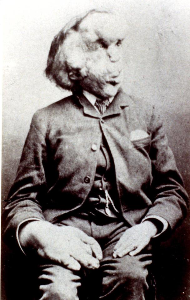  Joseph Merrick had a rare combination of diseases which caused the disfigurement