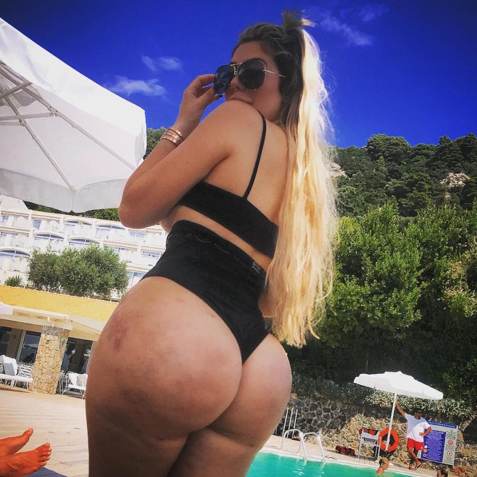  She recently shard this candid picture of her liposuction bruises and told her fans it was 'one for the haters'