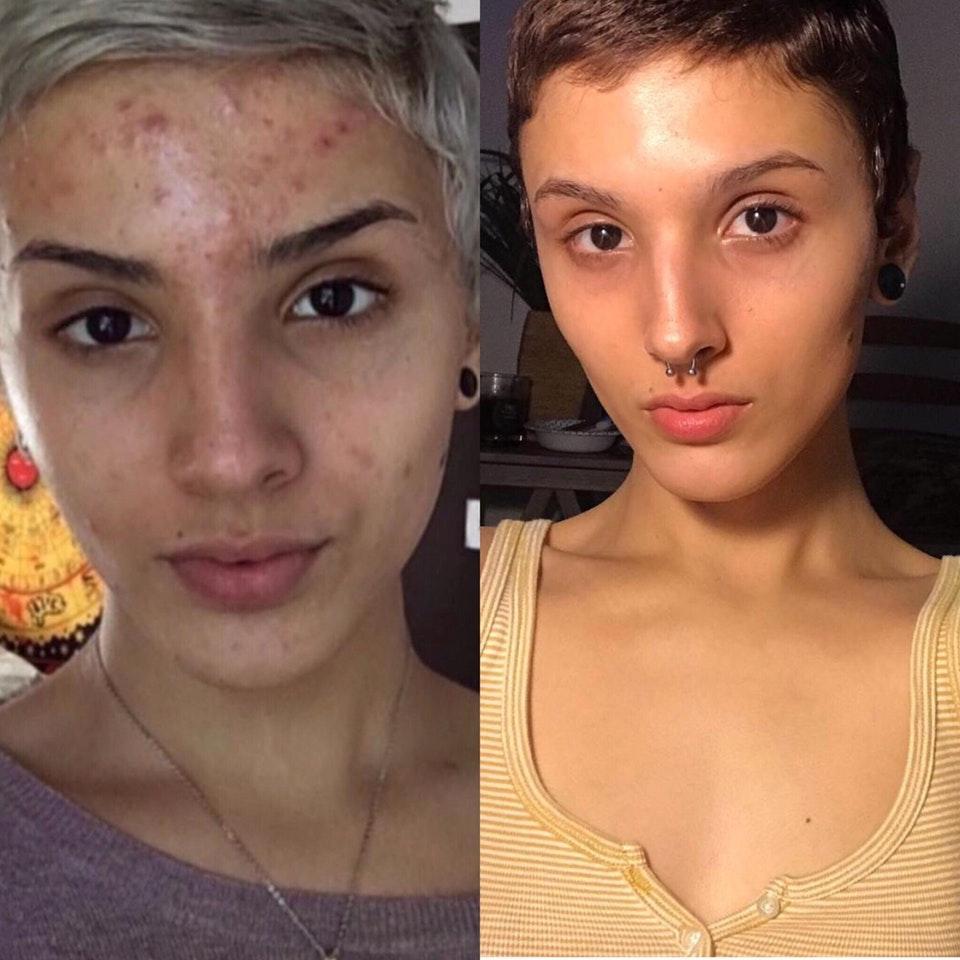  This Reddit user shared her dramatic transformation after using retinoid drug for her acne