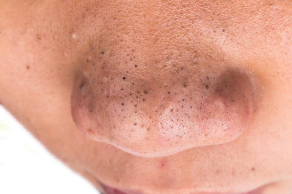 The best way to treat blackheads is through chemical exfoliation