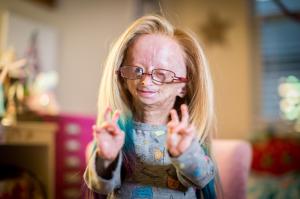  Adalia Rose was a famous YouTuber who suffered from the condition