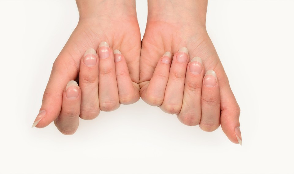 White spots can be a sign of nail trauma