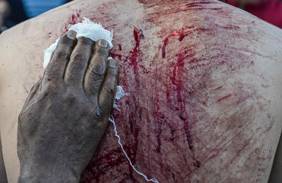 Wounds are cleaned on a man's back after he is cut to ribbons