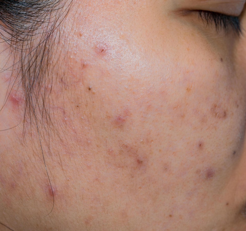 Some acne sufferers are also left with scarring