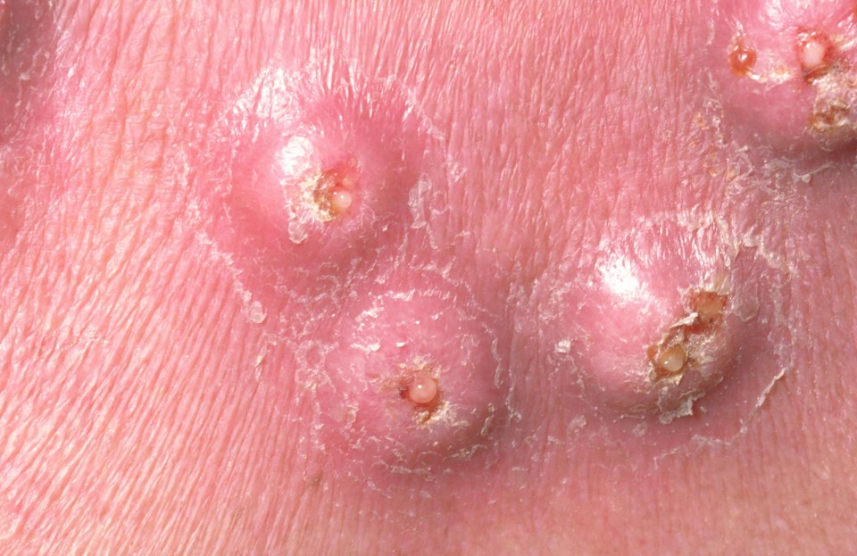 Nodules usually need a course of antibiotics to treat