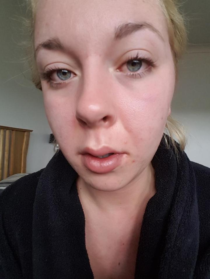  After starting using CBD capsules Emily noticed a huge difference in her skin