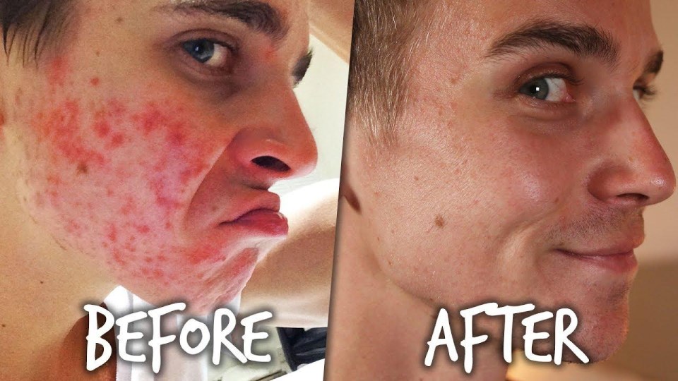 Joe Sugg revealed how he used to have acne, but that it has since cleared up