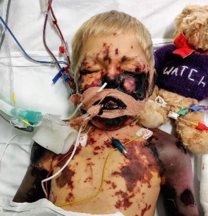  His family released this image of him to warn others of the danger of meningitis