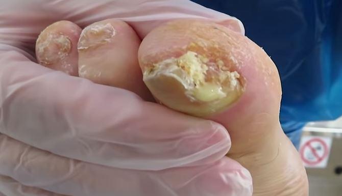  The podiatrist was surprised by the large amount of pus that oozed from the toe