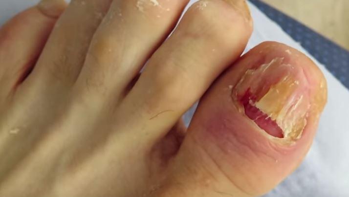  The majority of the nail had to be cut away to remove the infection