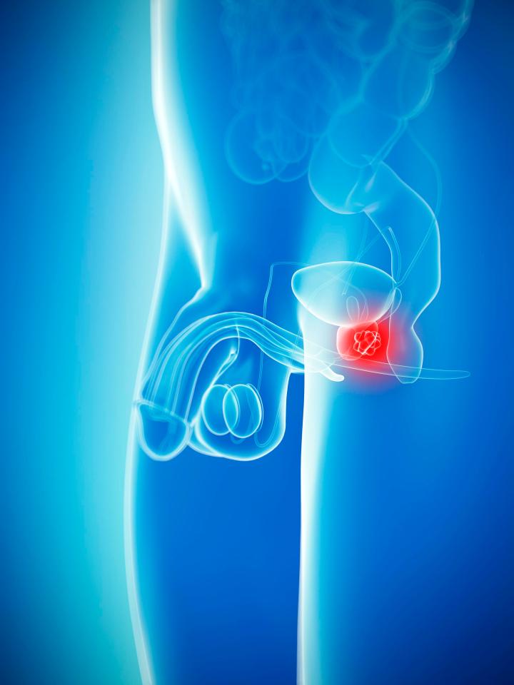  The prostate sits just between the penis and bladder