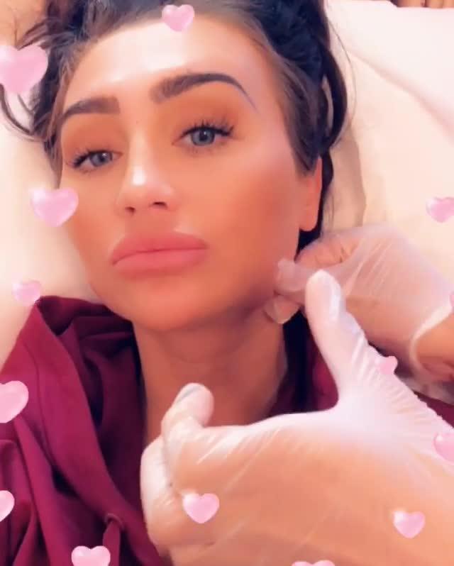  Lauren got her jaw fillers dissolved this week