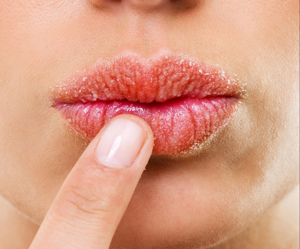 If you've got constantly cracked, chapped lips it could be a sign you have an iron deficiency