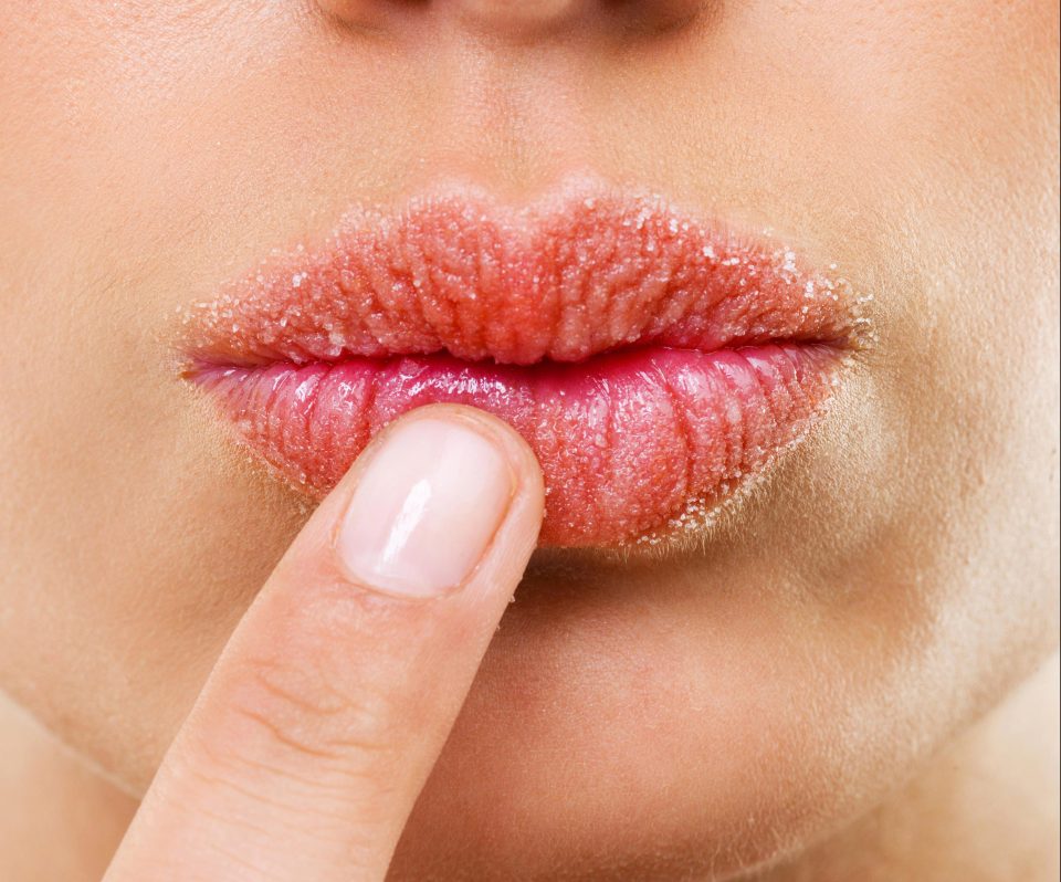 If you've got constantly cracked, chapped lips it could be a sign you have an underlying health issue