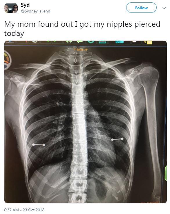  When Sydney shared her X-ray to Twitter, people found it hilarious