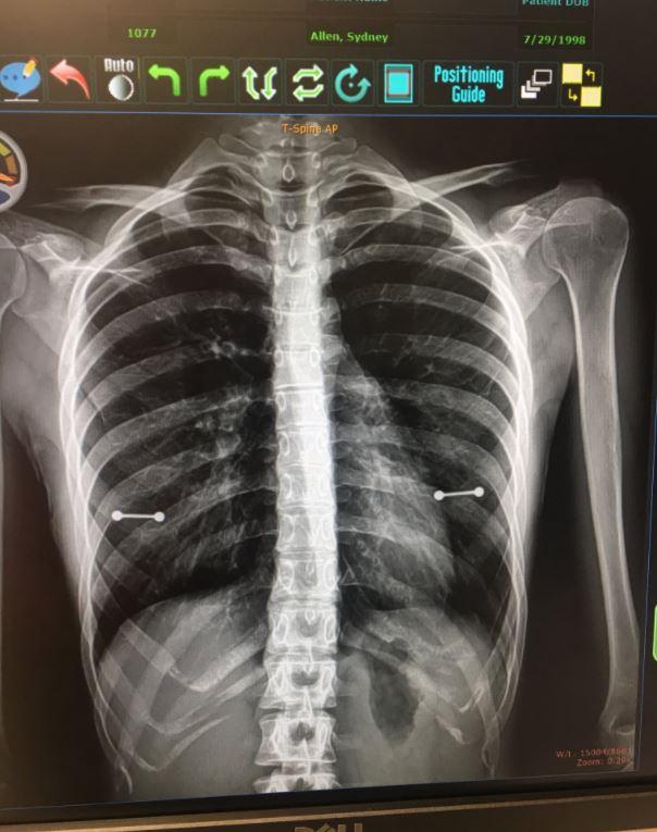  Sydney Allen's mum discovered her daughter's nipple piercings through this X-ray