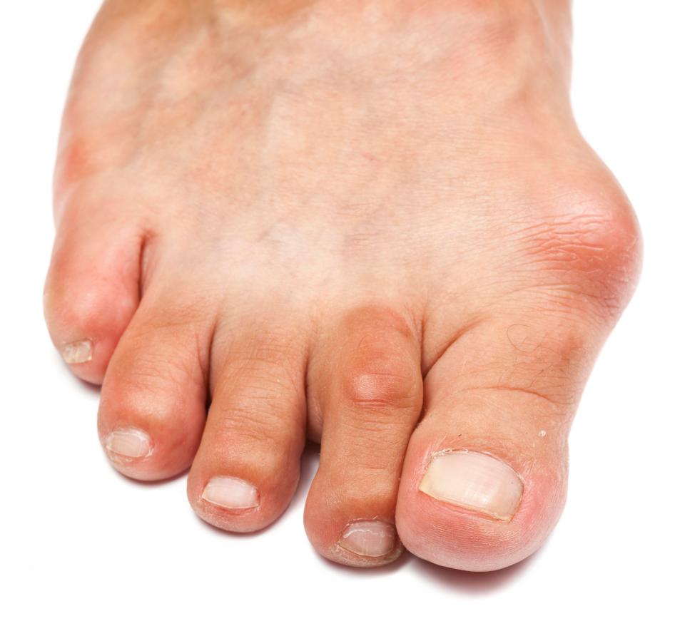 Gout causes swelling, pain and redness, usually in the big toe