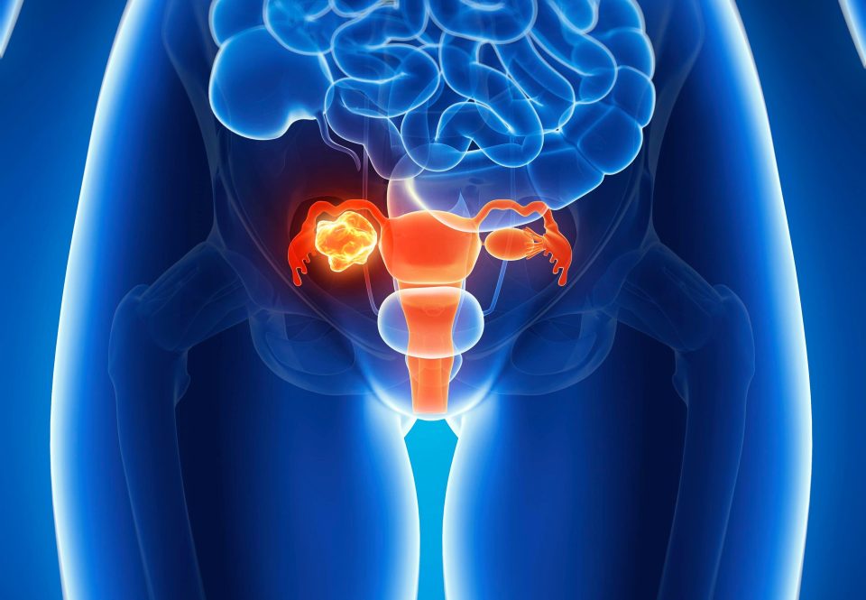  Ovarian cancer affects the ovaries, which are a small pair of organs located in the female pelvic cavity - about 7,000 women are diagnosed in the UK each year