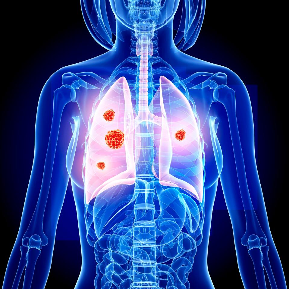  Lung cancer is the most deadly of all the cancers but is largely preventable