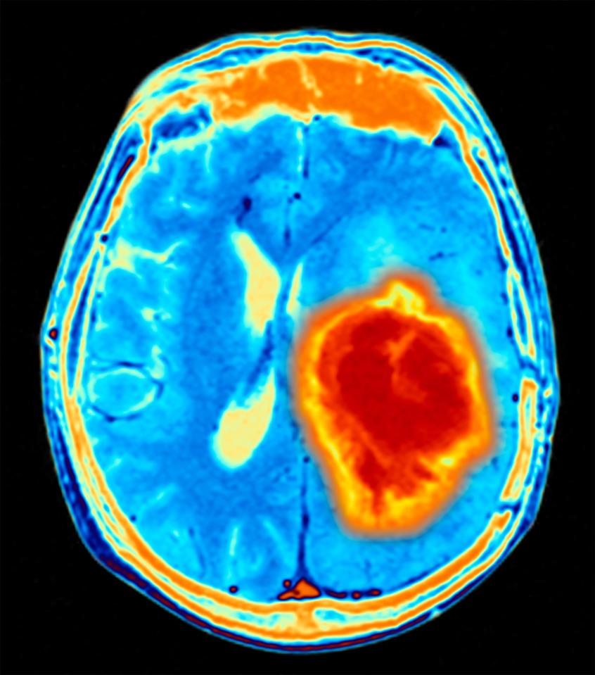  Long-term headache, vommitting and poor coordination are all signs of brain cancer - although they can also be caused by other, less serious complaints