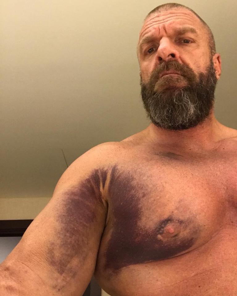 The Game showed off the huge bruising on his body after he tore his pectoral muscle