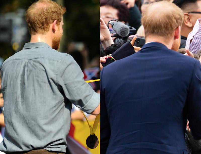 Prince Harry’s bald patch has DOUBLED in the last year – as these pics from the 2017 Invictus Games ceremony, left, and in Australia last month, right, show