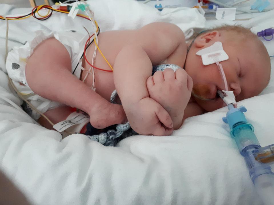  Baby Baron was born with caudal regression syndrome