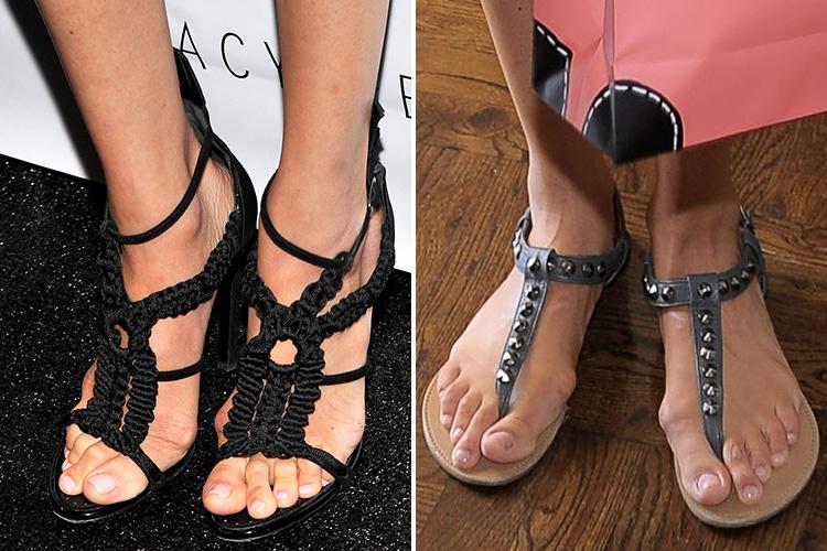 Meghan's bunions looked swollen and sore in 2013 (l) and 2010 (r)