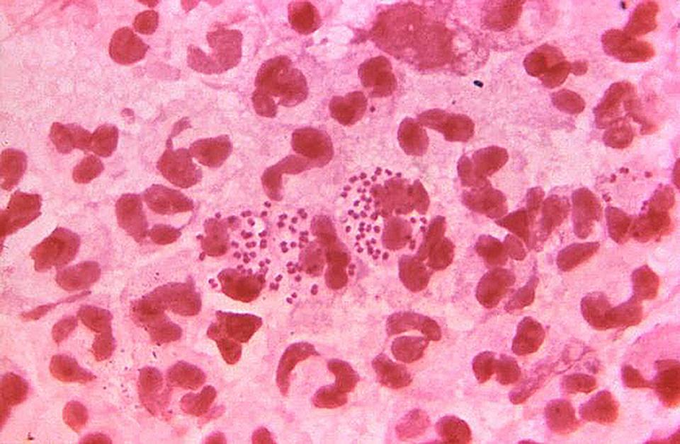  Drug resistant super-gonorrhoea is on the rise