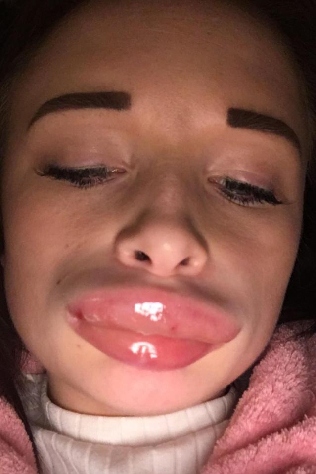  Billie Roocroft, 23, got the £120 fillers done on her living room sofa