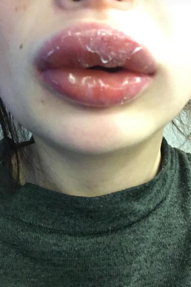  Her lips started peeling because they were so swollen - and she had to go to A&E for seven hours