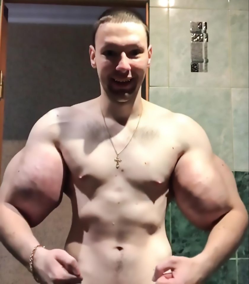  The bodybuilder was dubbed ‘Popeye’ and 'Bazooka arms' after injecting himself himself with synthol