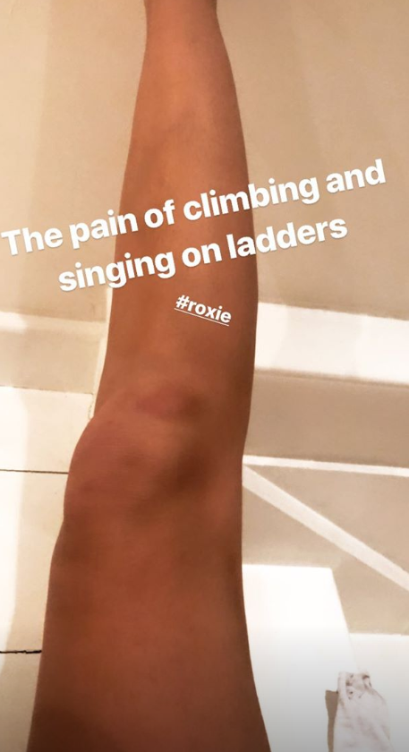  All her hard work has come at a price as she's been left with bruises from the gruelling rehearsals