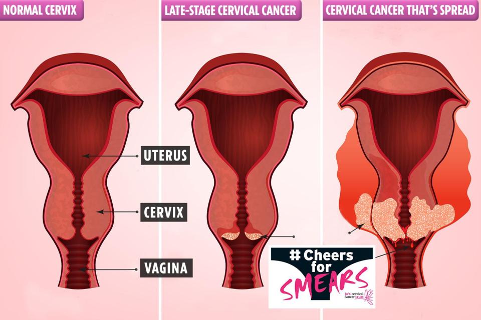  Cervical cancer is almost always treatable if it's caught early on