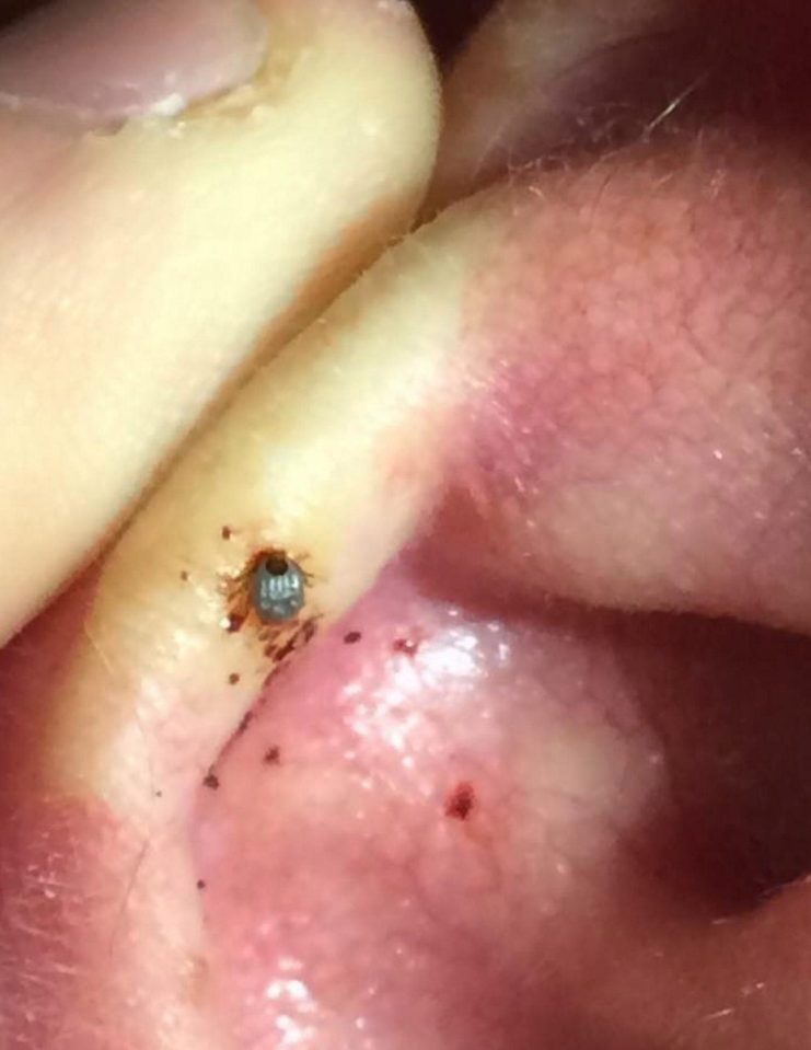  Pictured is the tick which Keith found embedded in his ear