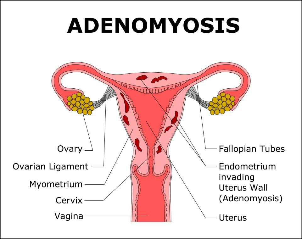 Adenomyosis is a condition of the uterus, where the tissue that grows on the lining of the uterus is also present on the inside muscular wall of the uterus