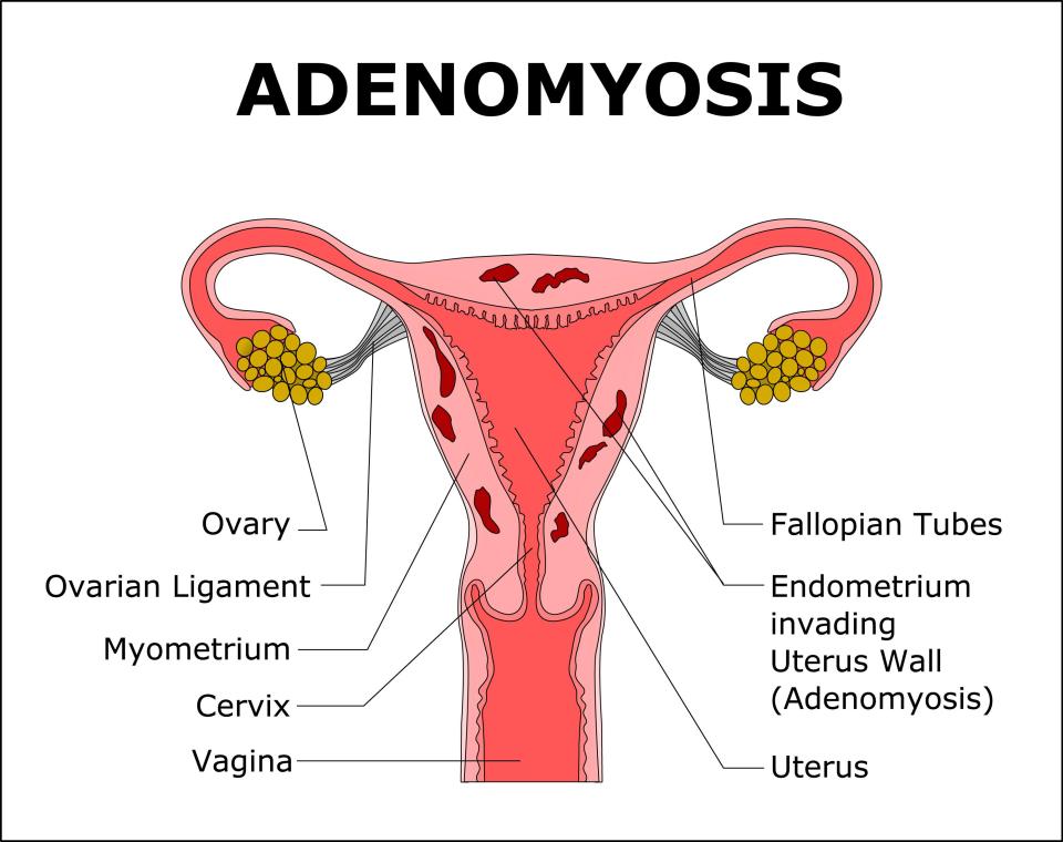  Adenomyosis is a condition of the uterus, where the tissue that grows on the lining of the uterus is also present on the inside muscular wall of the uterus