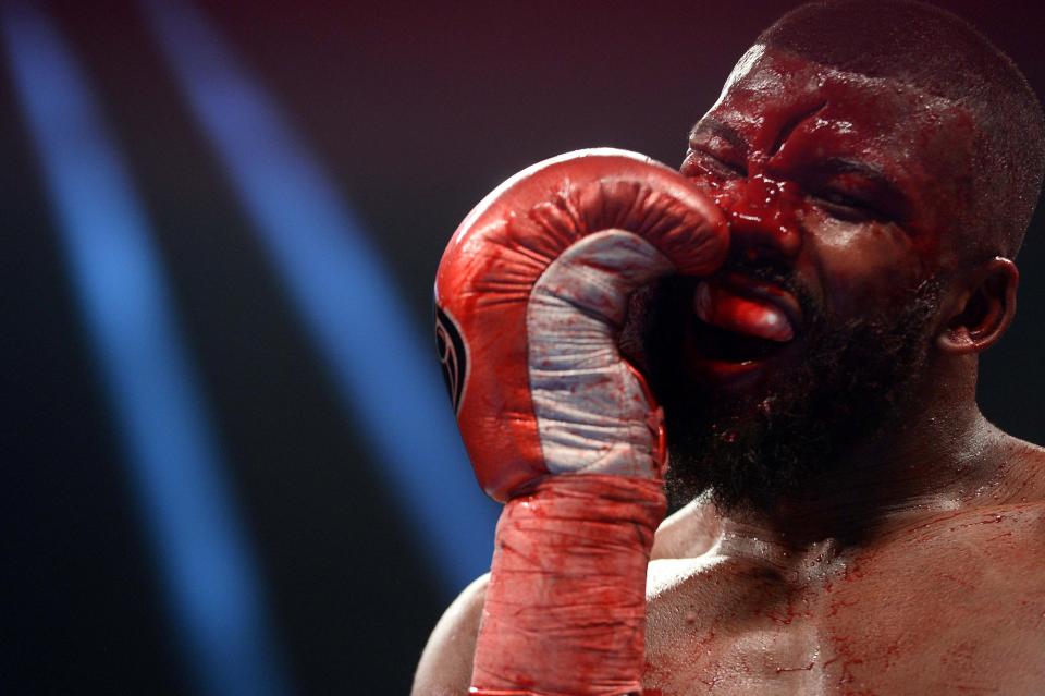  Jack suffered a nasty cut on his forehead leaving him with 25 stitches after defeat by Marcus Browne w