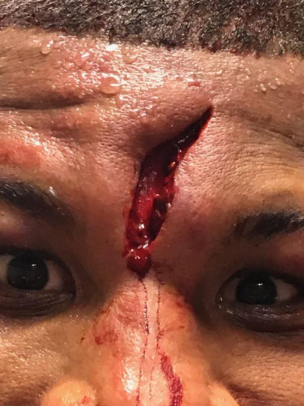  This was the horror gash that led to blood spilling out all over the ring in Las Vegas