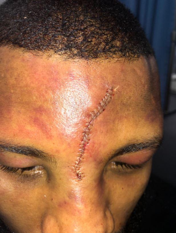  Incredibly the 25-year-old Swedish boxer managed to fight on for six rounds with the horror cut