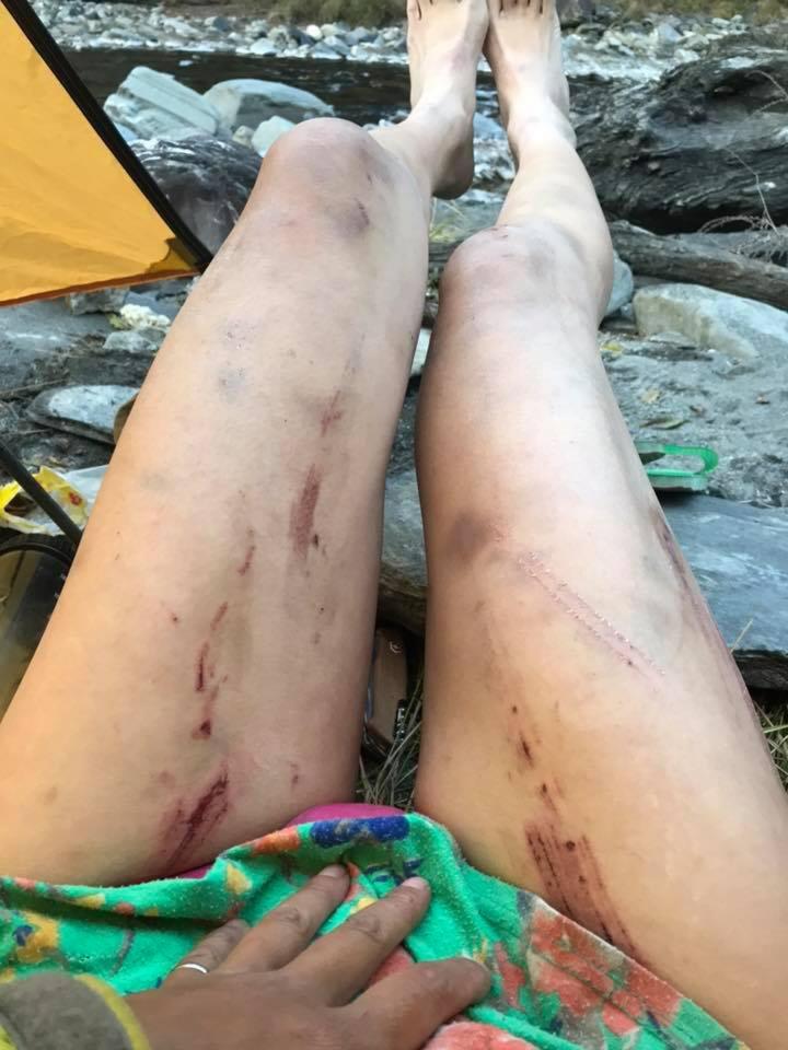  Wu shared a photo of injuries sustained during another fall, which she survived