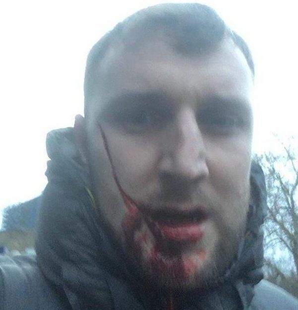 Everton fan Jay Burns was slashed from his ear to his mouth by a Millwall hooligan last year