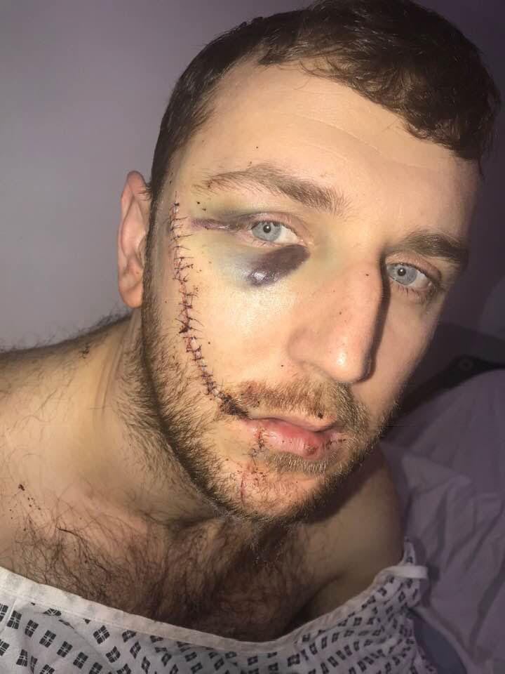  Everton fan Jay Burns was slashed across the face in the brawl