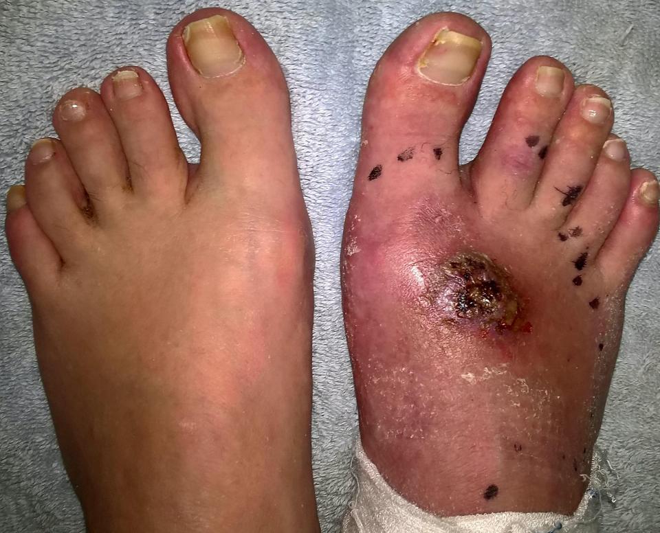  Gemma Hunter, 41, was left in agony after her foot swelled just days after medics say a false widow sank its teeth into her twice