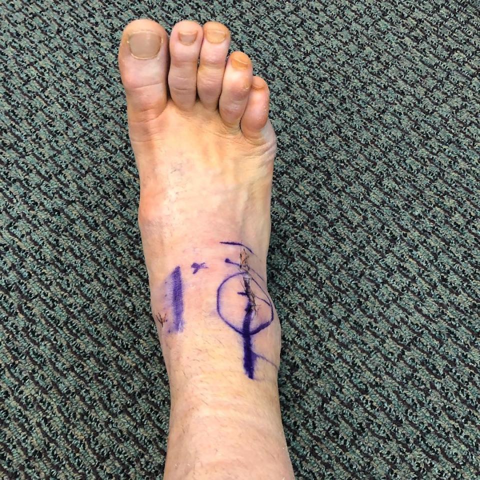  This was the UFC fighter's foot before the operation this week